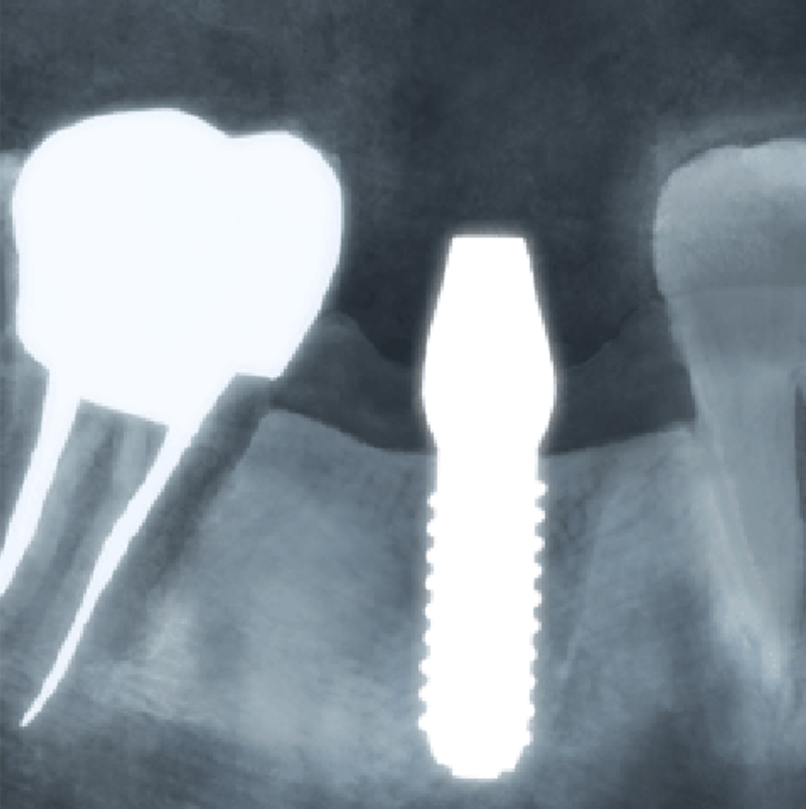 高円寺駅南口徒歩2分の歯医者、高円寺PAL歯科医院のインプラント治療の流れ