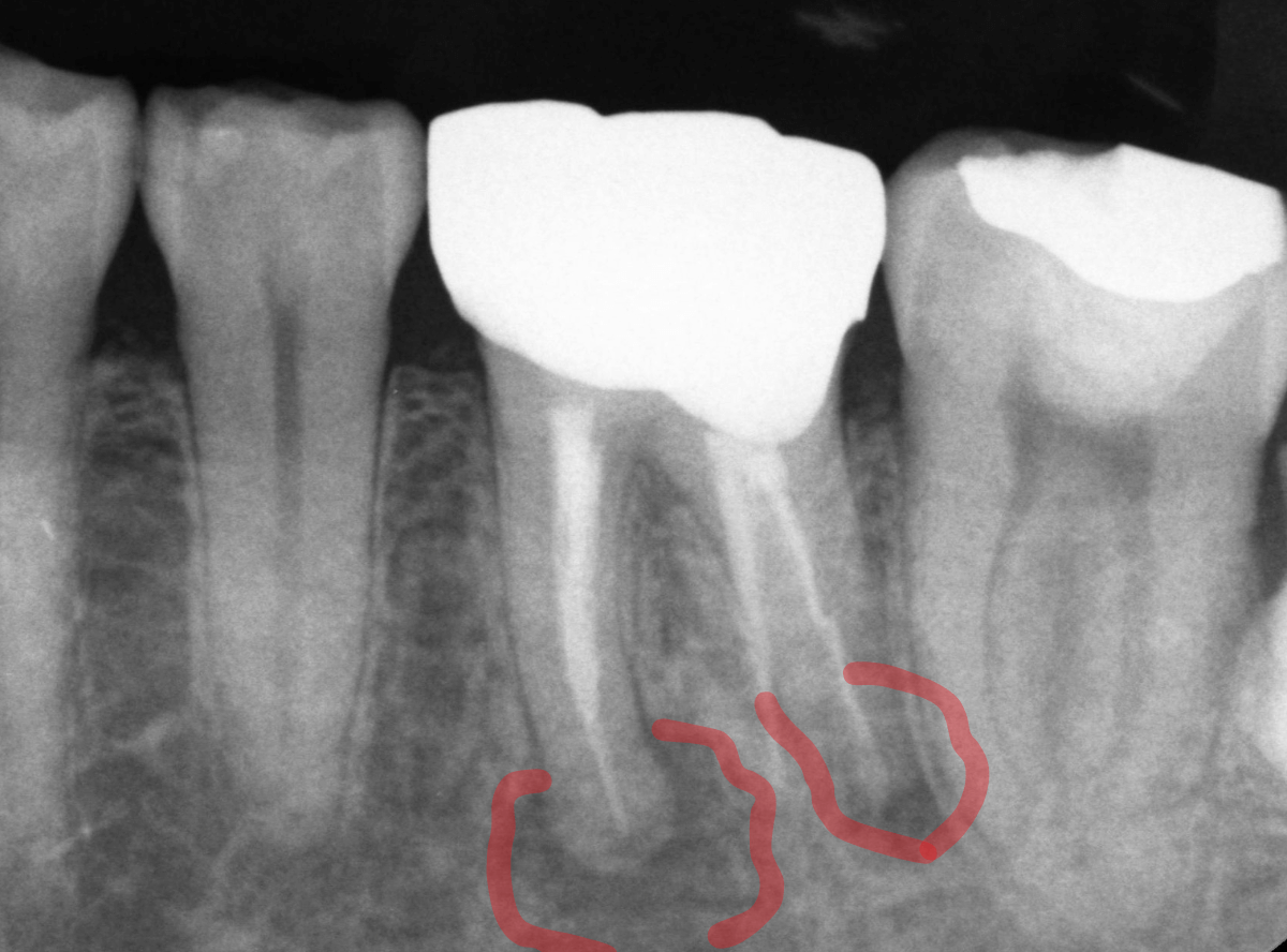 高円寺駅南口徒歩2分の歯医者、高円寺PAL歯科医院の根管治療