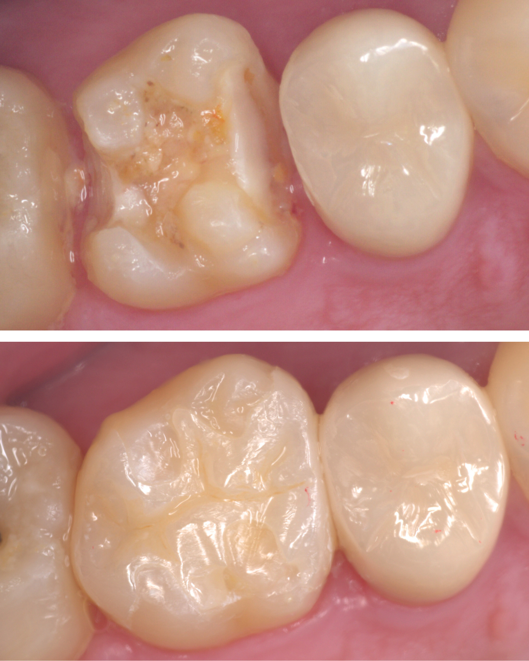 高円寺駅南口徒歩2分の歯医者、高円寺PAL歯科医院の歯を残す治療