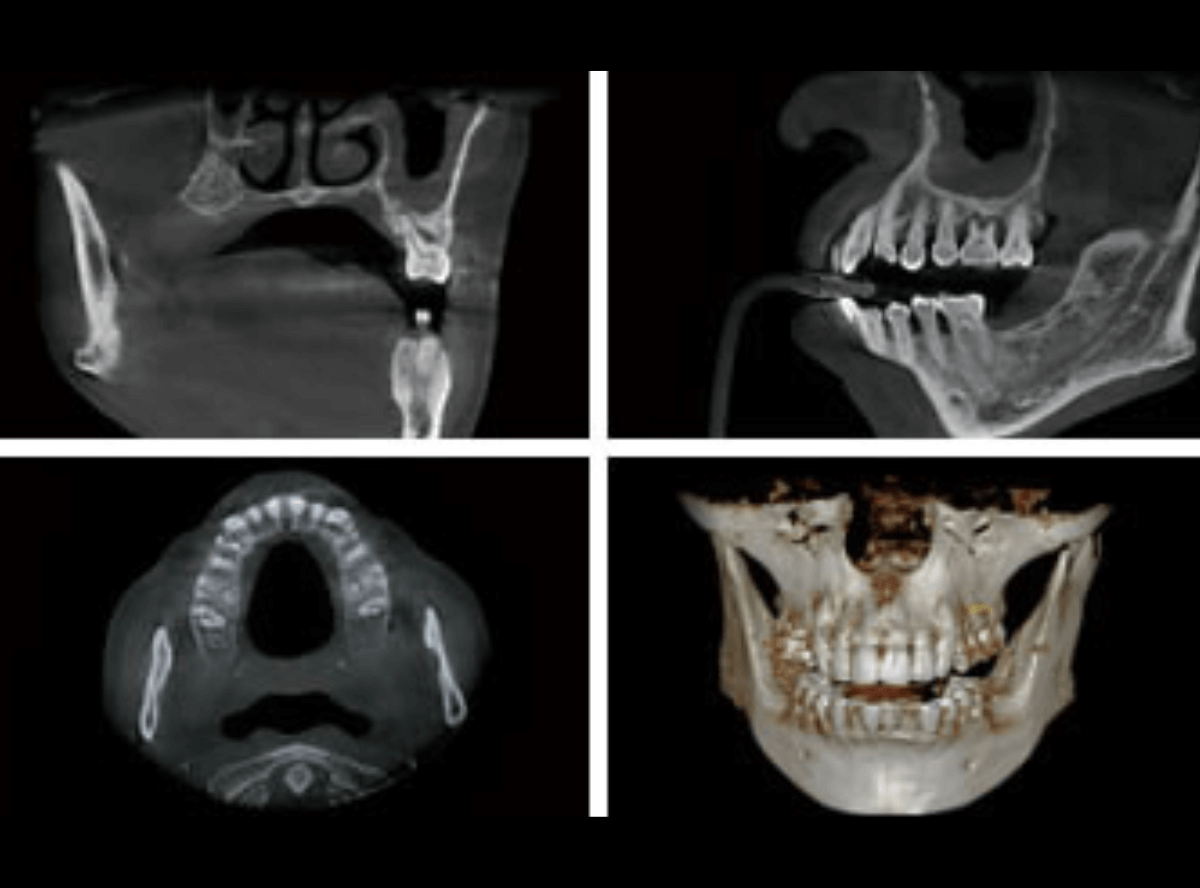 高円寺駅南口徒歩2分の歯医者、高円寺PAL歯科医院のCT撮影による、審査・診断