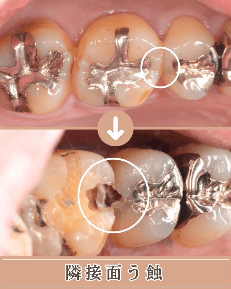 高円寺駅南口徒歩2分の歯医者、高円寺PAL歯科医院のむし歯治療