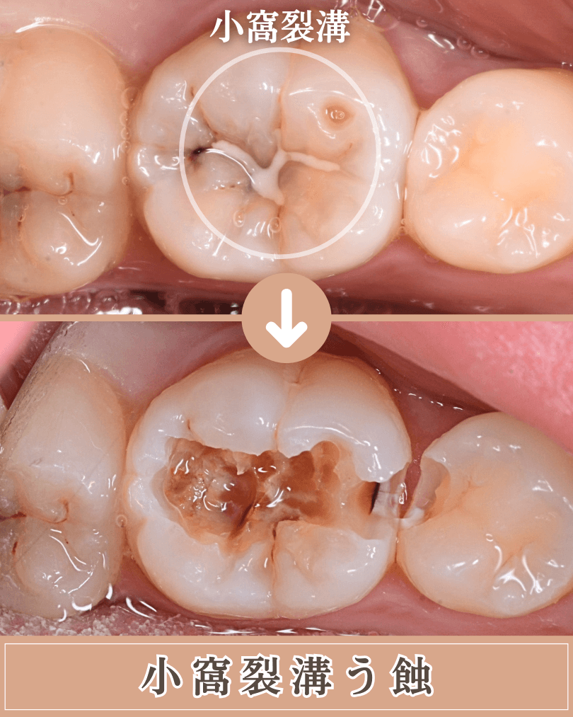 高円寺駅南口徒歩2分の歯医者、高円寺PAL歯科医院のむし歯治療