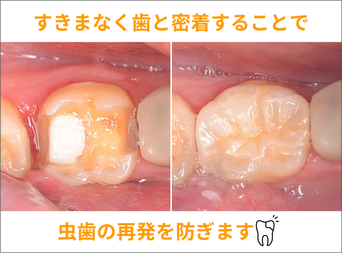 高円寺駅南口徒歩2分の歯医者、高円寺PAL歯科医院のセラミック治療