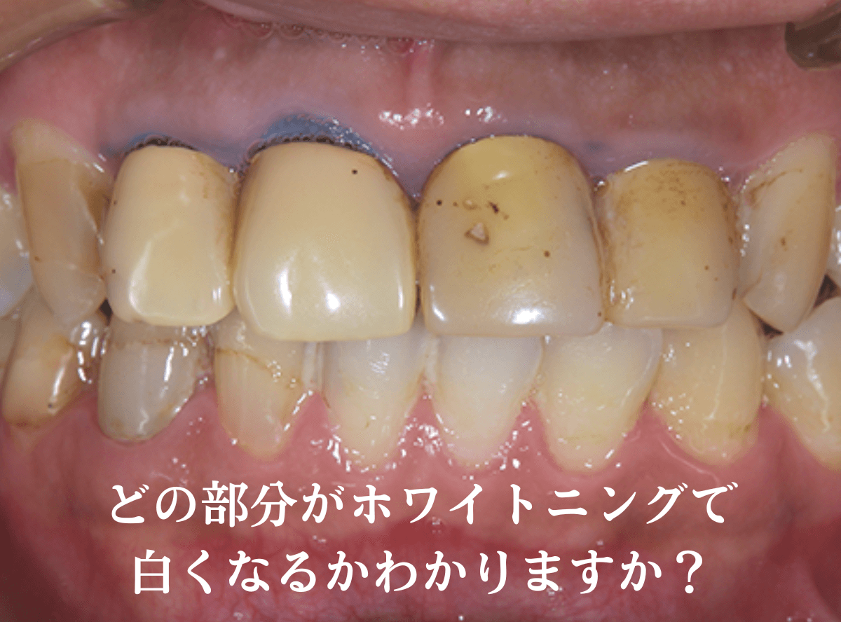 高円寺駅南口徒歩2分の歯医者、高円寺PAL歯科医院のホワイトニング