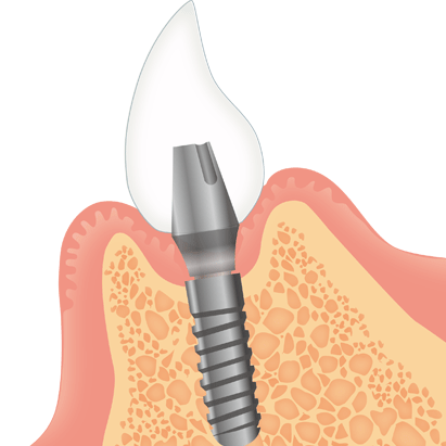 高円寺駅南口徒歩2分の歯医者、高円寺PAL歯科医院の入れ歯治療