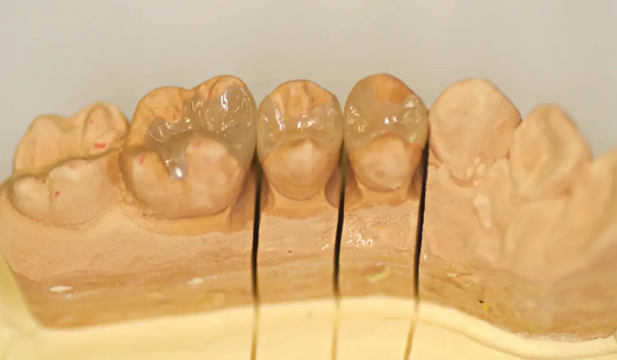 高円寺駅南口徒歩2分の歯医者、高円寺PAL歯科医院の歯を残す治療