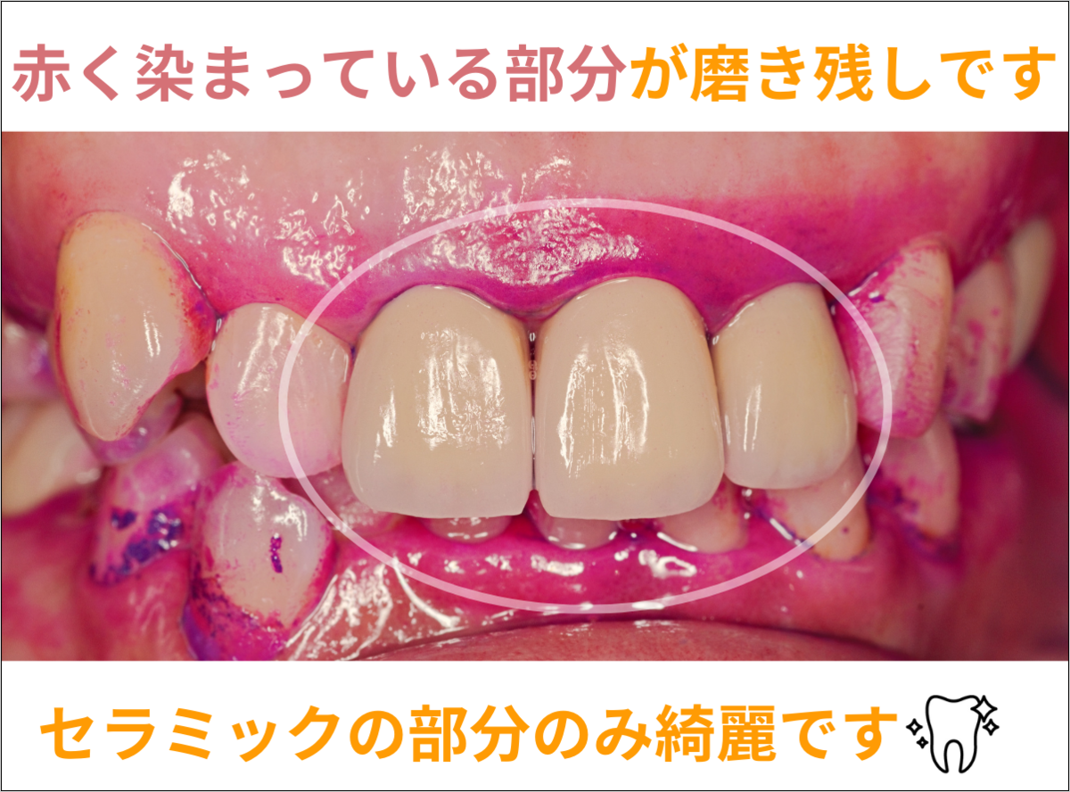 高円寺駅南口徒歩2分の歯医者、高円寺PAL歯科医院のセラミック治療