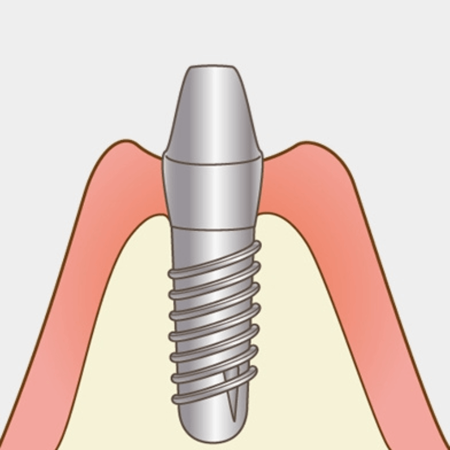 高円寺駅南口徒歩2分の歯医者、高円寺PAL歯科医院のインプラント治療の流れ