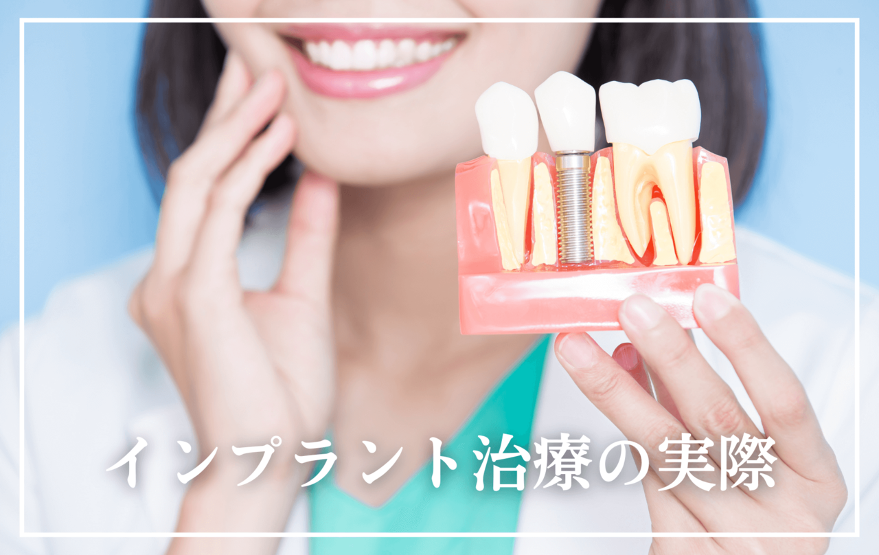 高円寺駅南口徒歩2分の歯医者、高円寺PAL歯科医院のインプラント治療