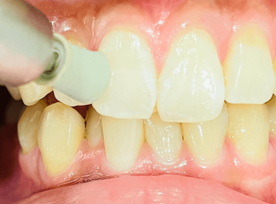 高円寺駅南口徒歩2分の歯医者、高円寺PAL歯科医院の治療後のメンテナンスの流れ