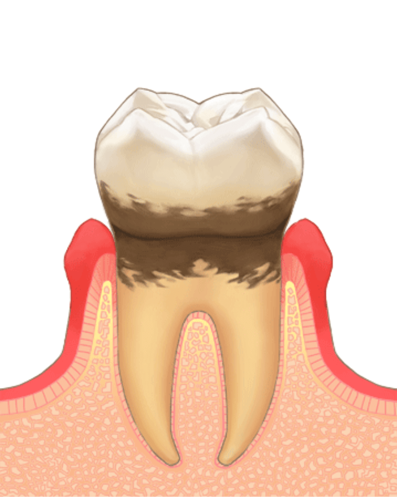 高円寺駅南口徒歩2分の歯医者、高円寺PAL歯科医院の歯周病治療