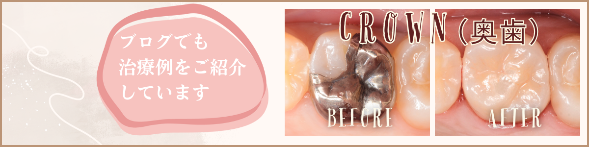 高円寺駅南口徒歩2分の歯医者、高円寺PAL歯科医院のセラミック治療