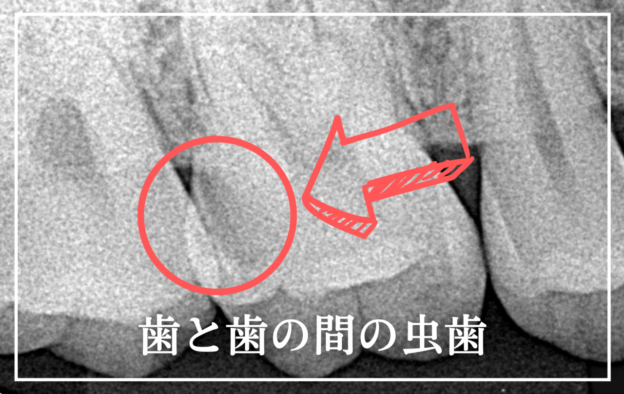 高円寺駅南口徒歩2分の歯医者、高円寺PAL歯科医院の歯と歯の間の虫歯(隣接面う蝕)