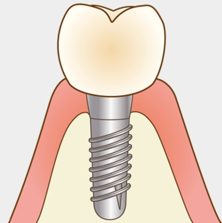 高円寺駅南口徒歩2分の歯医者、高円寺PAL歯科医院のインプラント治療の流れ