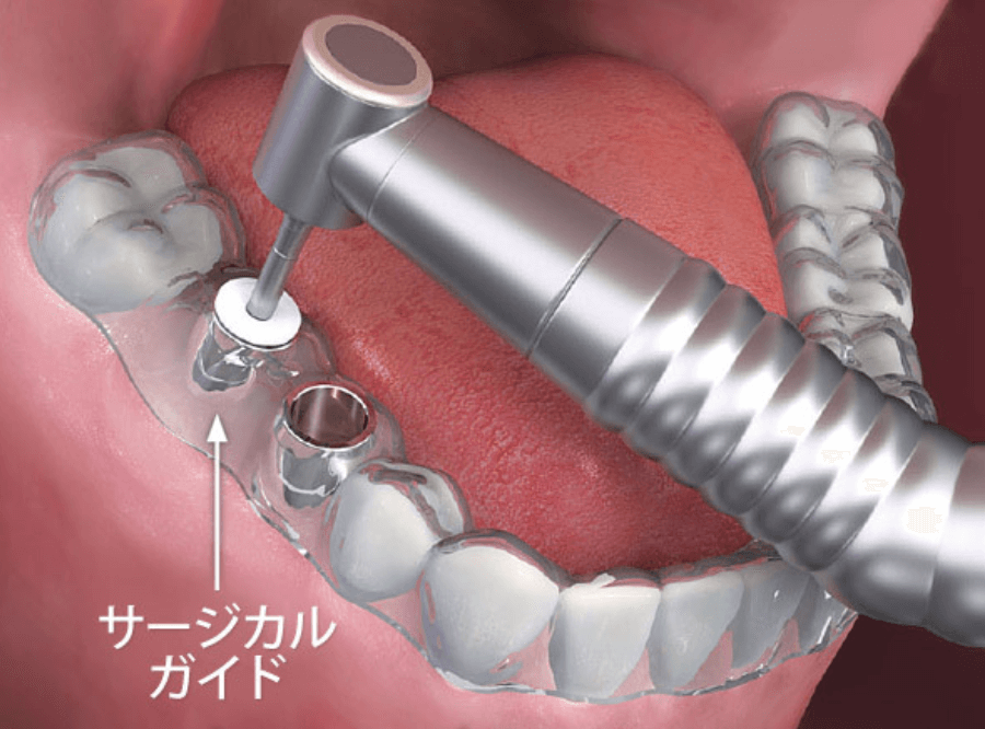 高円寺駅南口徒歩2分の歯医者、高円寺PAL歯科医院のサージカル・ガイド