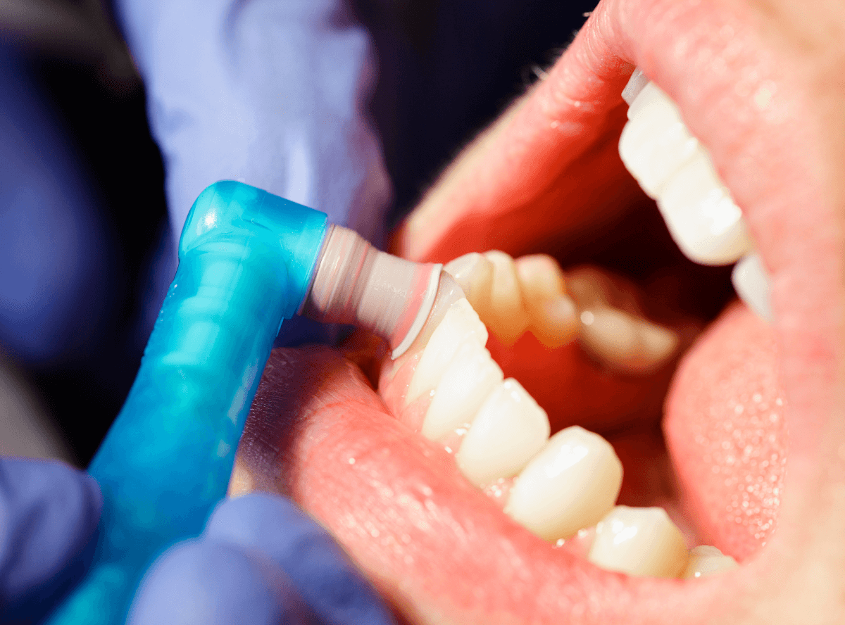 高円寺駅南口徒歩2分の歯医者、高円寺PAL歯科医院の治療後のメンテナンス