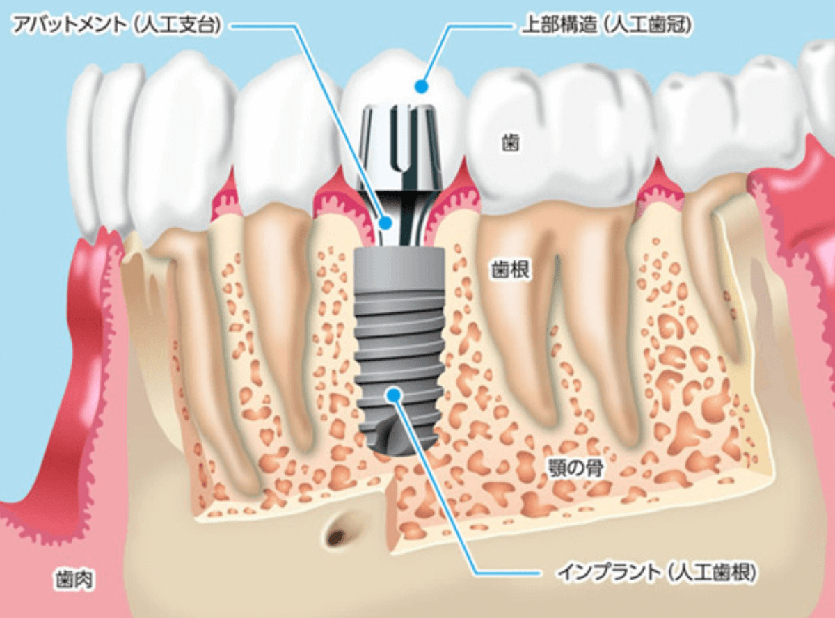 高円寺駅南口徒歩2分の歯医者、高円寺PAL歯科医院のインプラント治療