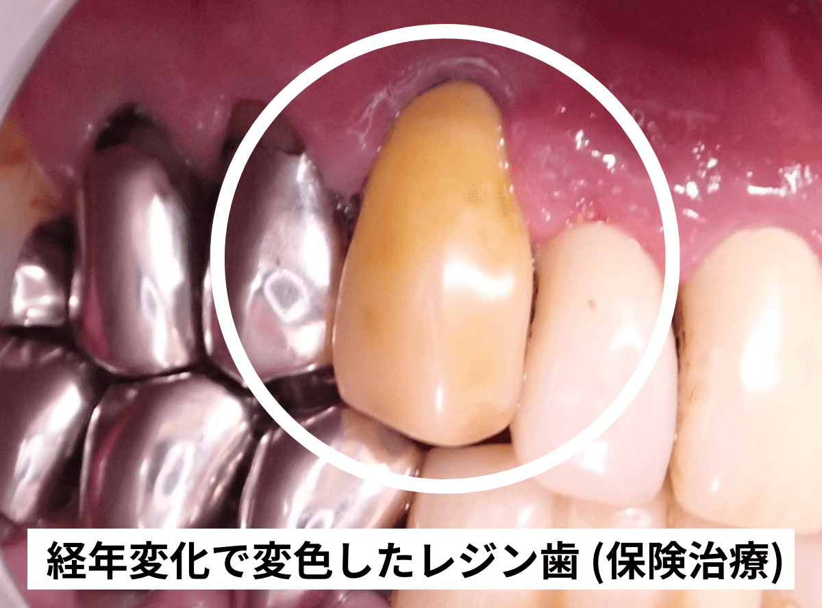 高円寺駅南口徒歩2分の歯医者、高円寺PAL歯科医院のセラミック治療