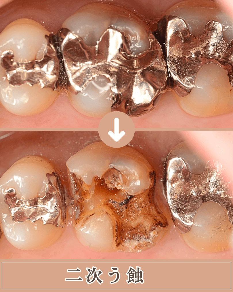 高円寺駅南口徒歩2分の歯医者、高円寺PAL歯科医院のむし歯治療