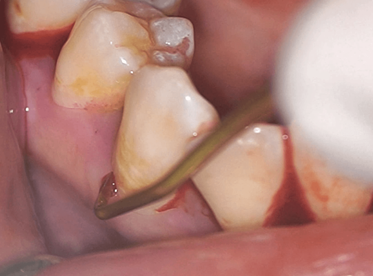 高円寺駅南口徒歩2分の歯医者、高円寺PAL歯科医院の歯周病治療