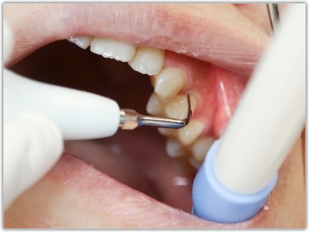 高円寺駅南口徒歩2分の歯医者、高円寺PAL歯科医院の歯周病治療