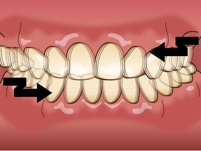 高円寺駅南口徒歩2分の歯医者、高円寺PAL歯科医院の歯ぎしり・食いしばり治療