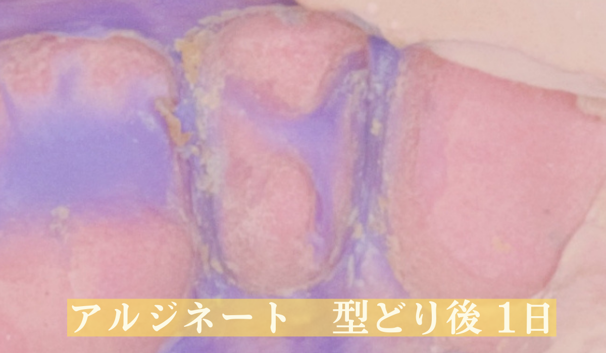 高円寺駅南口徒歩2分の歯医者、高円寺PAL歯科医院の歯を残す治療