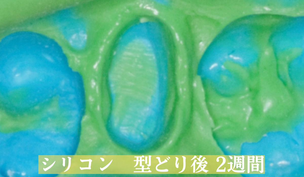 高円寺駅南口徒歩2分の歯医者、高円寺PAL歯科医院の歯を残す治療