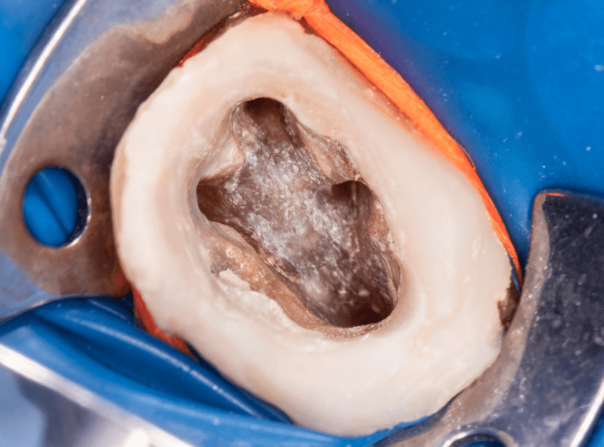 高円寺駅南口徒歩2分の歯医者、高円寺PAL歯科医院の根管治療