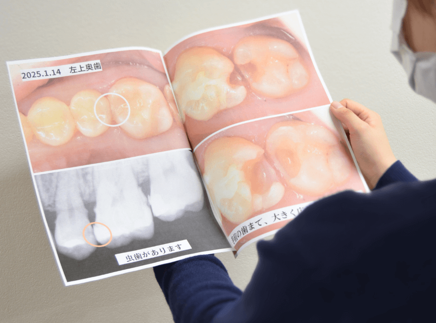 高円寺駅南口徒歩2分の歯医者、高円寺PAL歯科医院の歯を残す治療