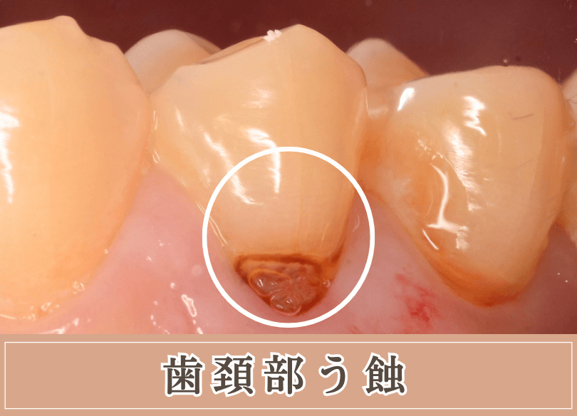 高円寺駅南口徒歩2分の歯医者、高円寺PAL歯科医院のむし歯治療