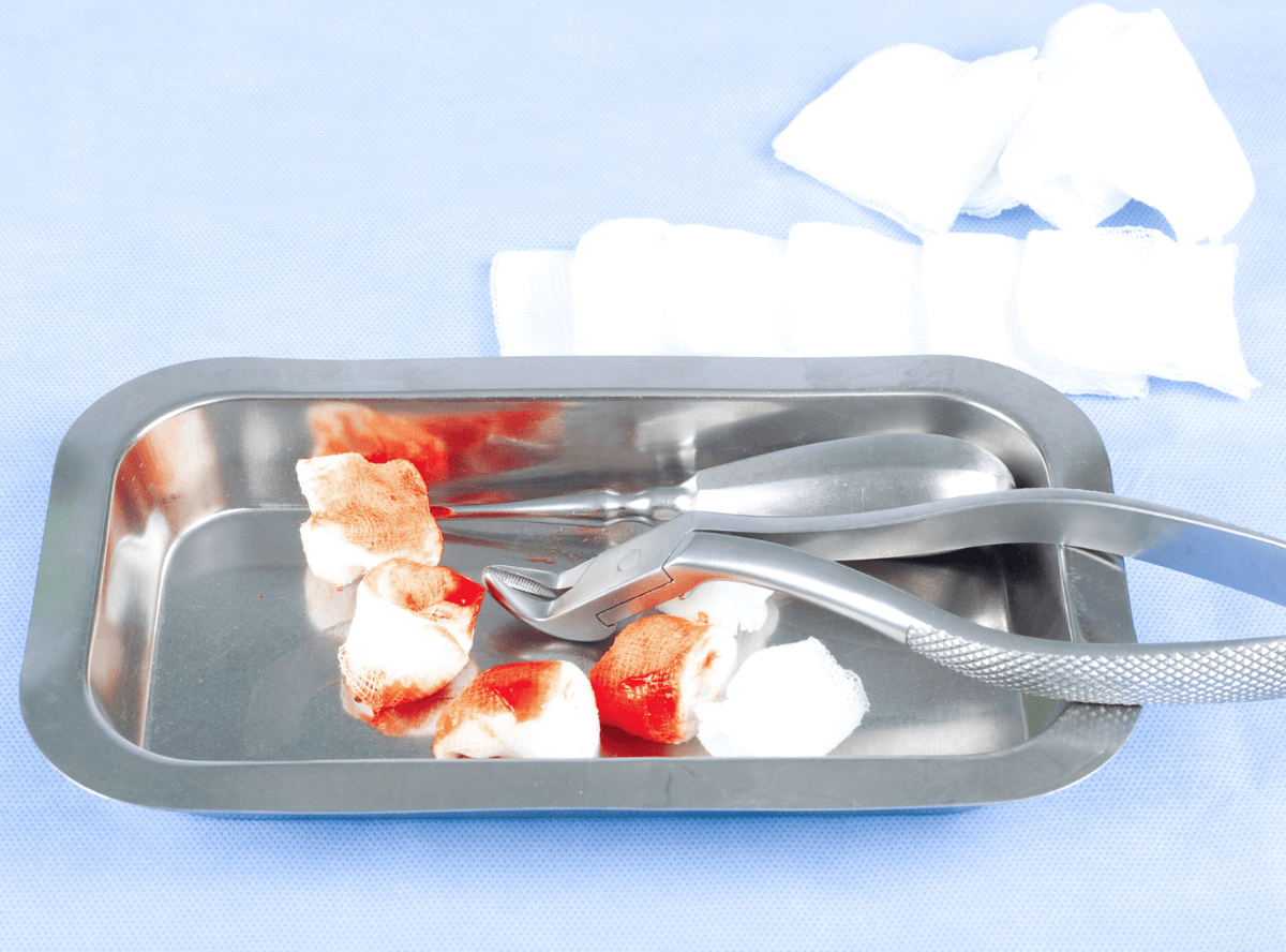 高円寺駅南口徒歩2分の歯医者、高円寺PAL歯科医院のインプラント治療の流れ