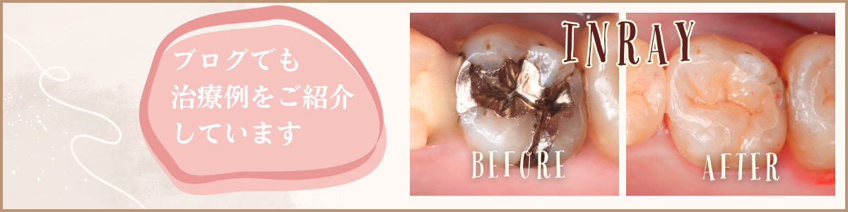 高円寺駅南口徒歩2分の歯医者、高円寺PAL歯科医院のセラミック治療