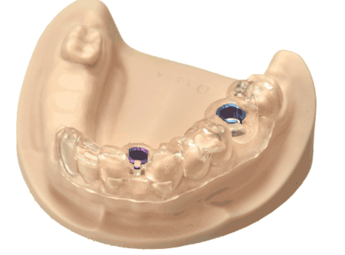 高円寺駅南口徒歩2分の歯医者、高円寺PAL歯科医院のインプラント治療の流れ