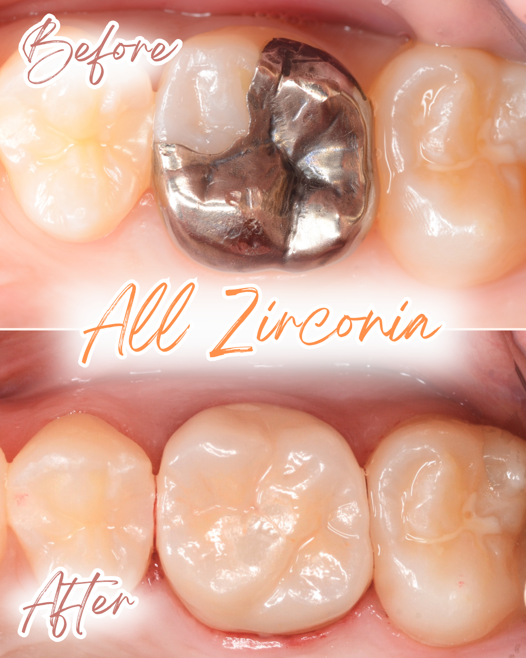 高円寺駅南口徒歩2分の歯医者、高円寺PAL歯科医院のセラミック治療