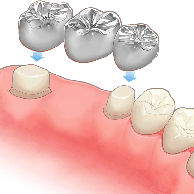 高円寺駅南口徒歩2分の歯医者、高円寺PAL歯科医院の入れ歯治療