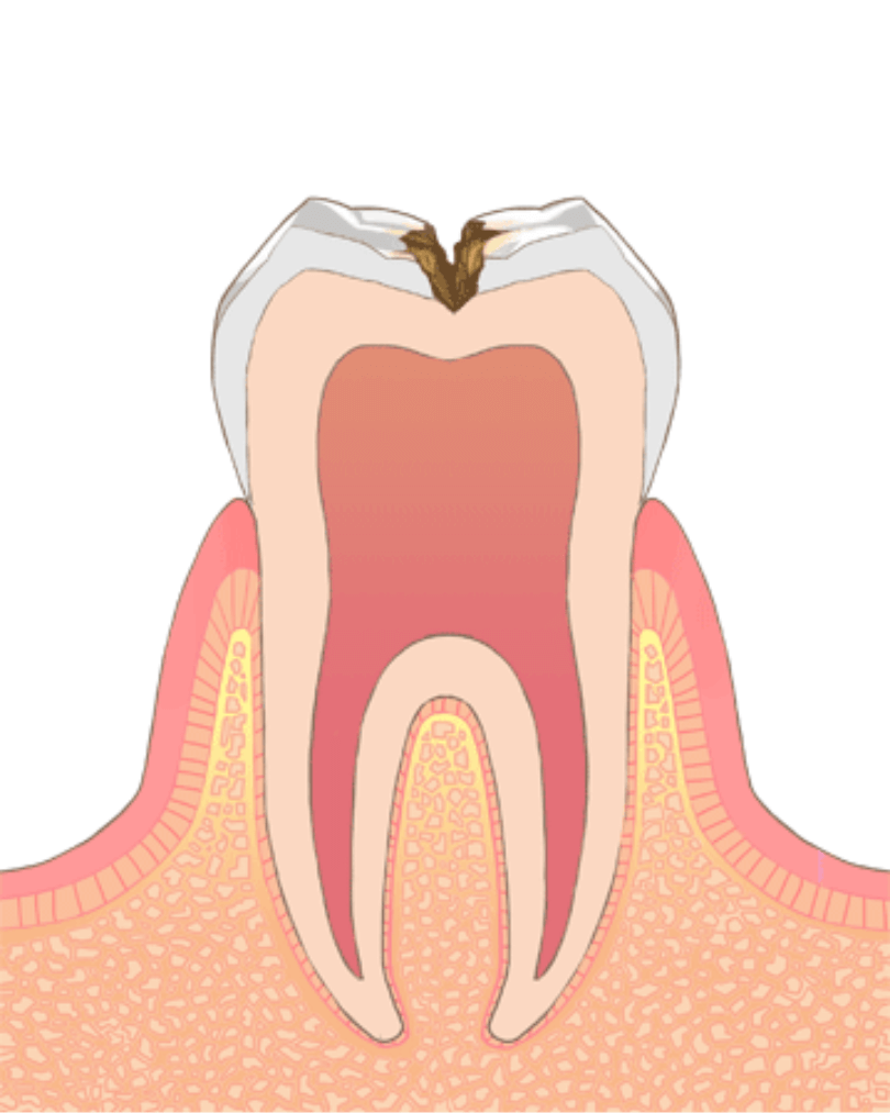 高円寺駅南口徒歩2分の歯医者、高円寺PAL歯科医院のむし歯治療