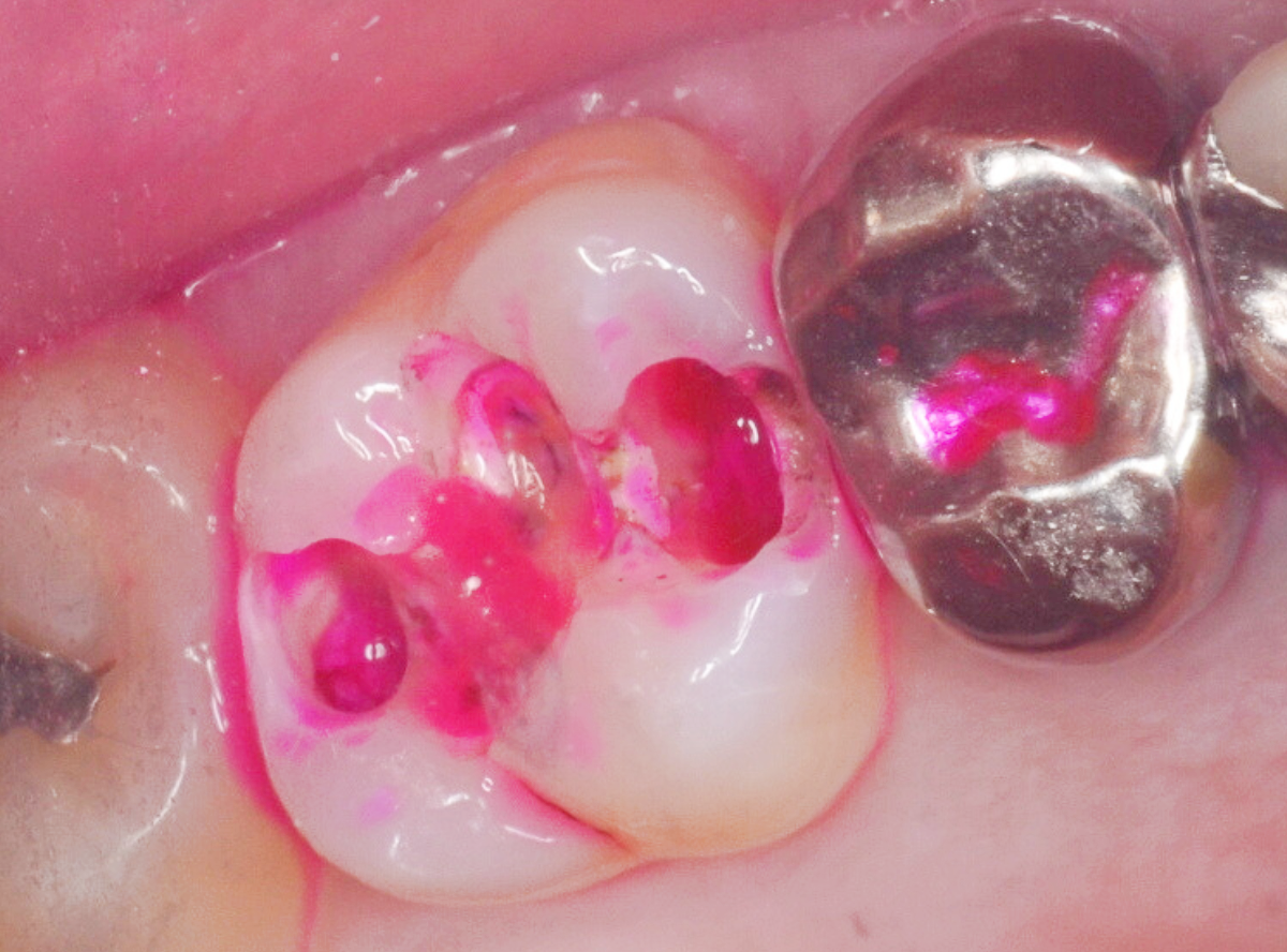 高円寺駅南口徒歩2分の歯医者、高円寺PAL歯科医院の歯を残す治療