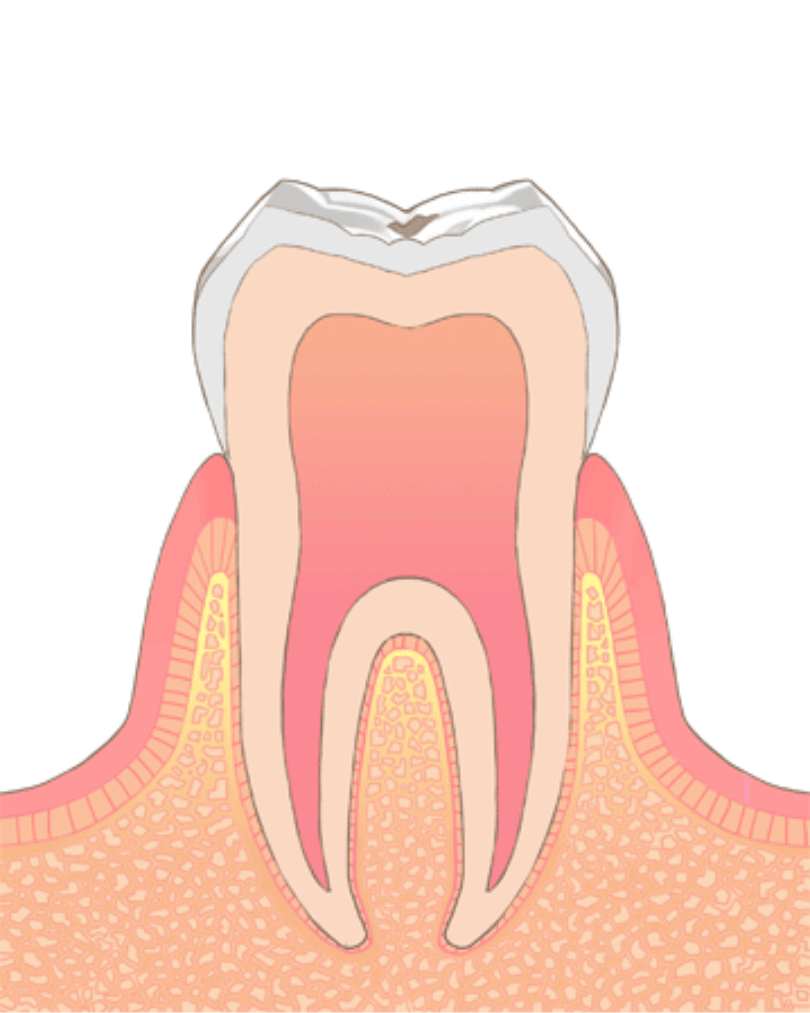 高円寺駅南口徒歩2分の歯医者、高円寺PAL歯科医院のむし歯治療