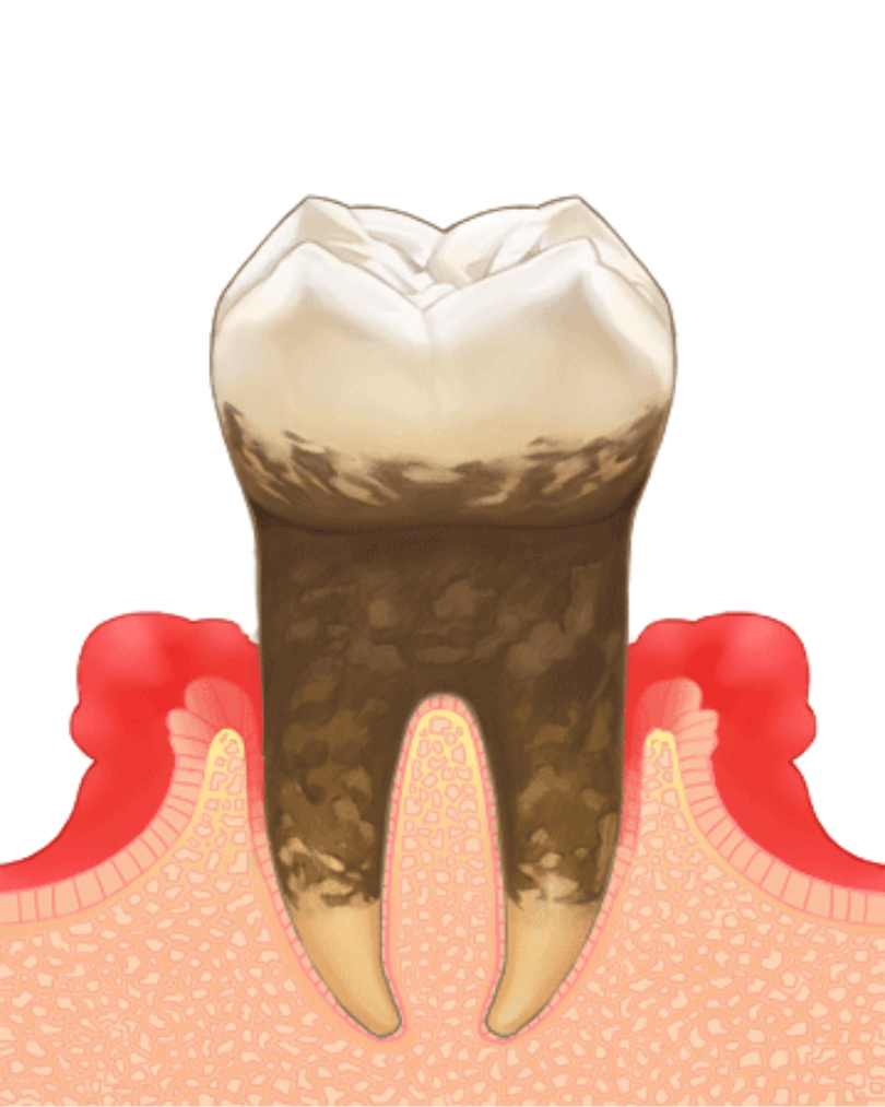 高円寺駅南口徒歩2分の歯医者、高円寺PAL歯科医院の歯周病治療