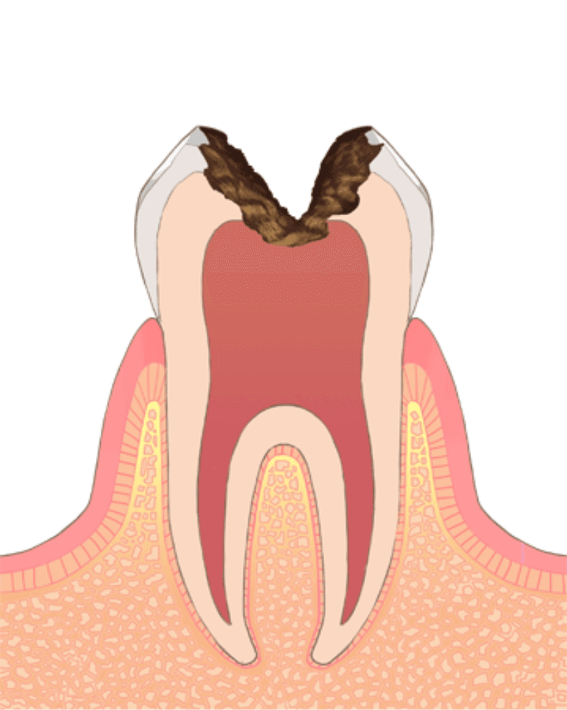 高円寺駅南口徒歩2分の歯医者、高円寺PAL歯科医院のむし歯治療