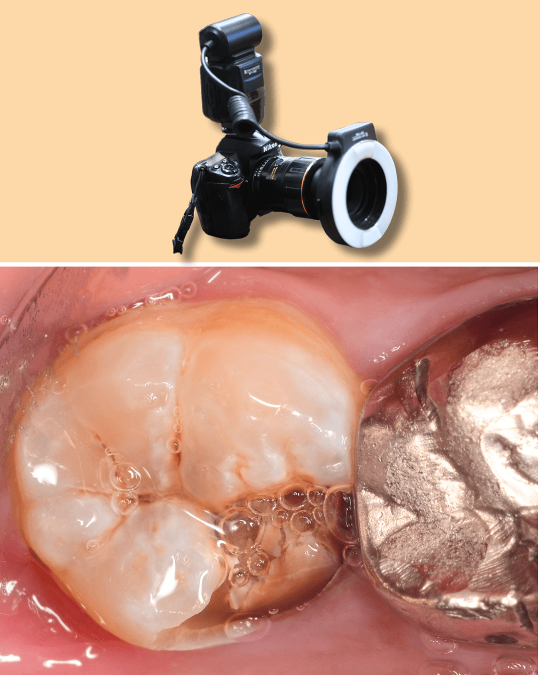 高円寺駅南口徒歩2分の歯医者、高円寺PAL歯科医院の歯を残す治療