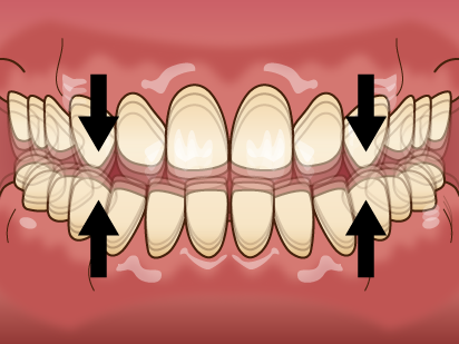 高円寺駅南口徒歩2分の歯医者、高円寺PAL歯科医院の歯ぎしり・食いしばり治療