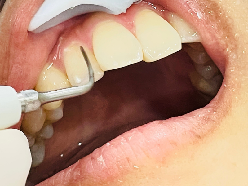 高円寺駅南口徒歩2分の歯医者、高円寺PAL歯科医院の歯周病・短期集中治療