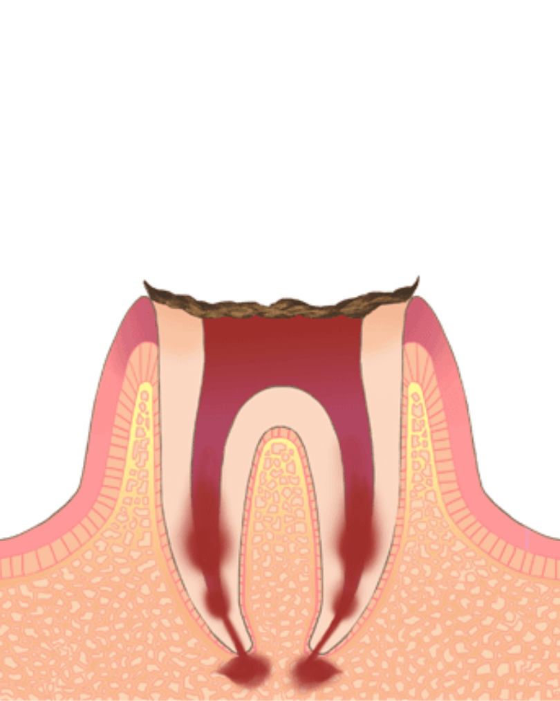 高円寺駅南口徒歩2分の歯医者、高円寺PAL歯科医院のむし歯治療