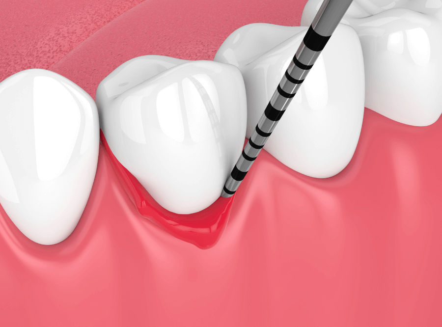 高円寺駅南口徒歩2分の歯医者、高円寺PAL歯科医院の治療後のメンテナンスの流れ