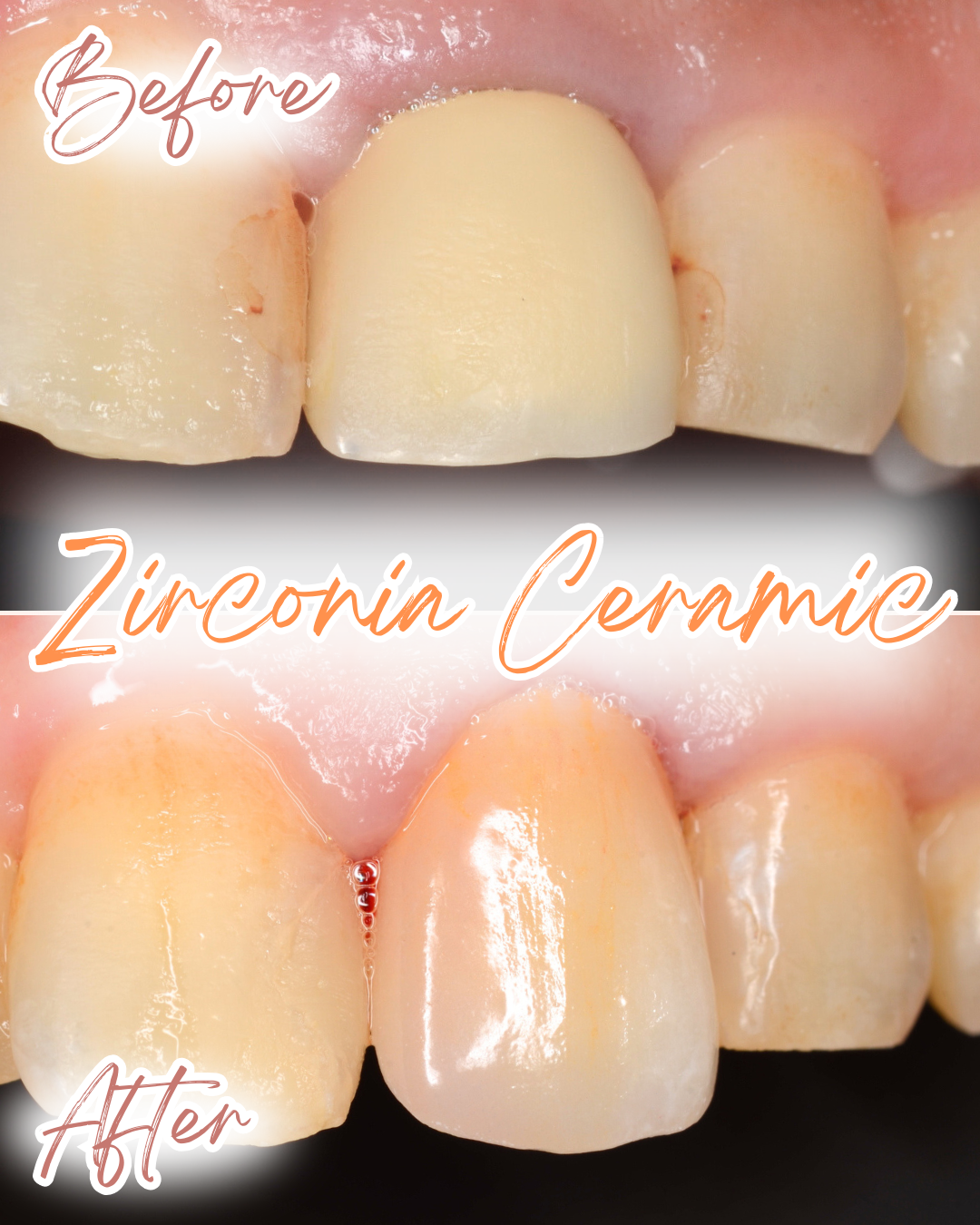 高円寺駅南口徒歩2分の歯医者、高円寺PAL歯科医院のセラミック治療