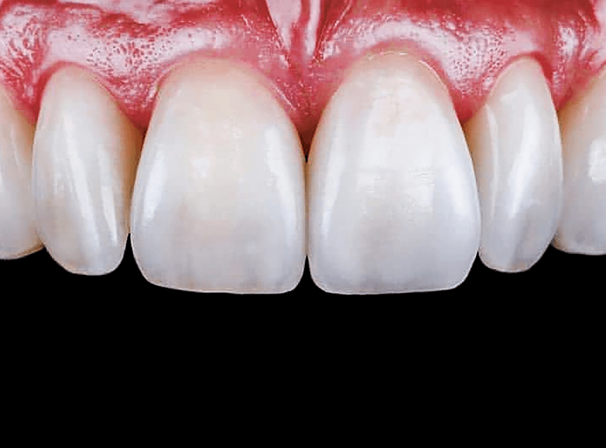 高円寺駅南口徒歩2分の歯医者、高円寺PAL歯科医院のセラミック治療