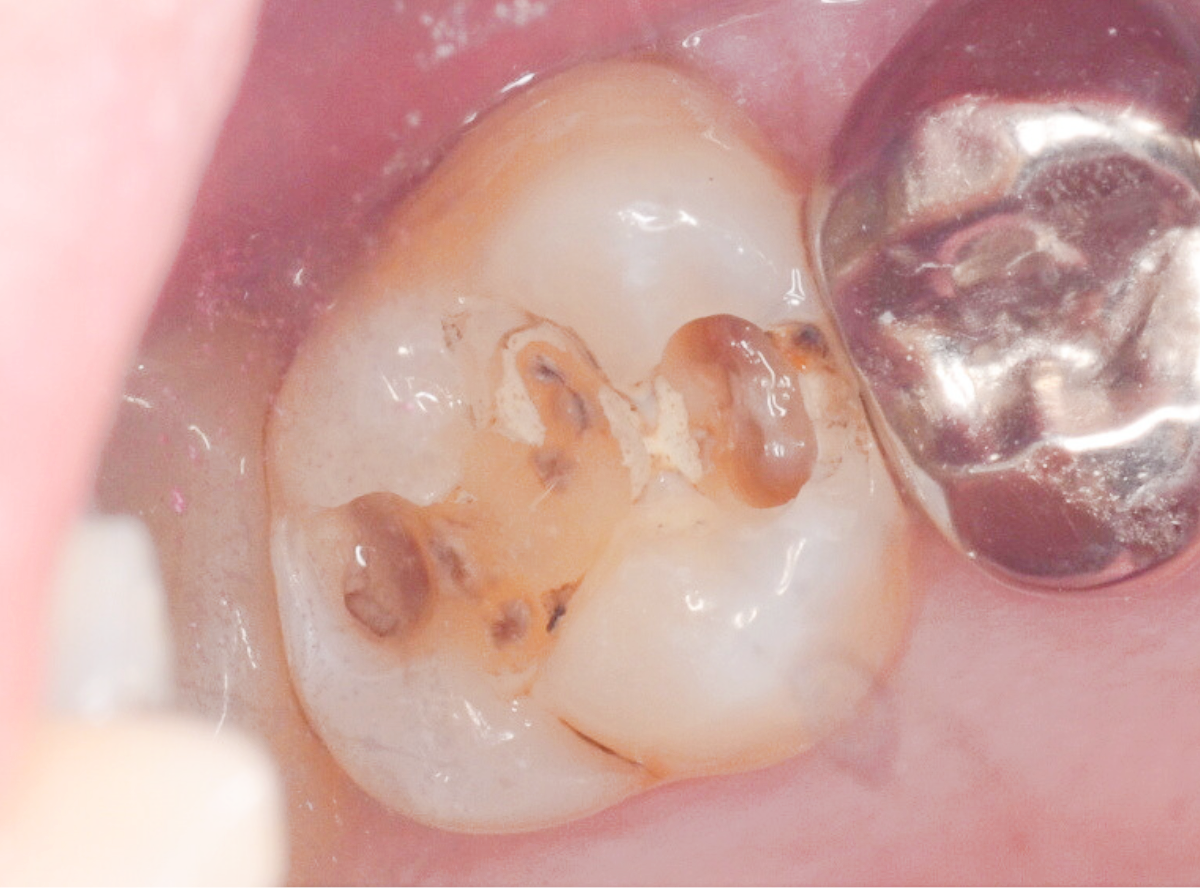 高円寺駅南口徒歩2分の歯医者、高円寺PAL歯科医院の歯を残す治療