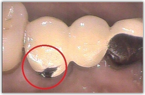 高円寺駅南口徒歩2分の歯医者、高円寺PAL歯科医院の歯ぎしり・食いしばり治療